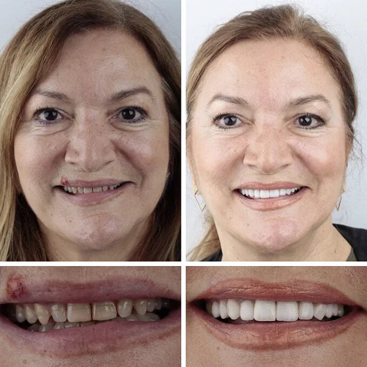 🔥Ends Today: 79% OFF! ⏰DarkFairy™ Medical Full Denture with Strong Suctiond Custom-Fit Full Functional Dentures🦷