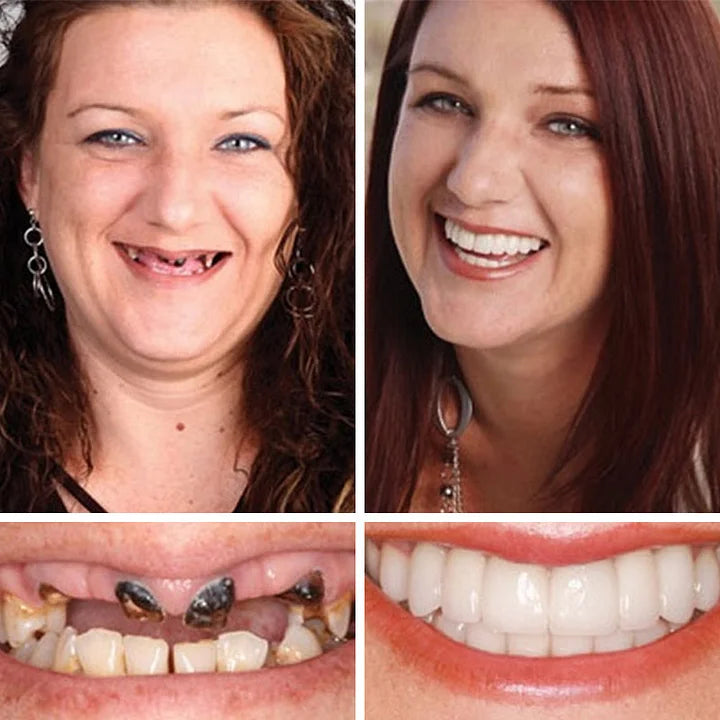 🔥Ends Today: 79% OFF! ⏰DarkFairy™ Medical Full Denture with Strong Suctiond Custom-Fit Full Functional Dentures🦷