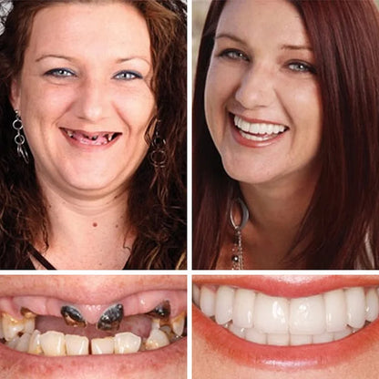 🔥Ends Today: 79% OFF! ⏰DarkFairy™ Medical Full Denture with Strong Suctiond Custom-Fit Full Functional Dentures🦷