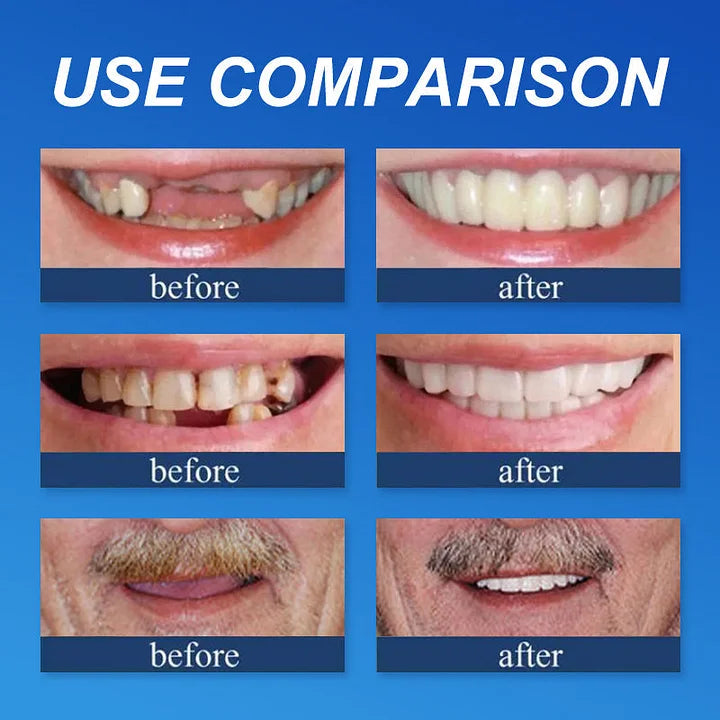 🔥Ends Today: 79% OFF! ⏰DarkFairy™ Medical Full Denture with Strong Suctiond Custom-Fit Full Functional Dentures🦷