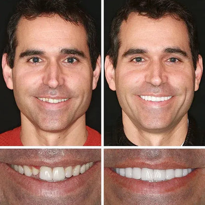 🔥Ends Today: 79% OFF!🏆2026 Bestselling Product🦷 Fit for a Fresh Smile, Say Goodbye to Wearing Discomfort!🌎